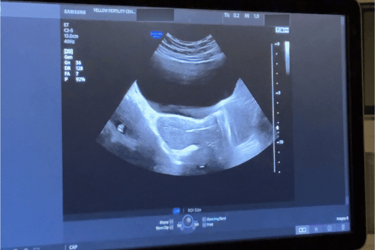 Dos and Don’ts After Embryo Transfer